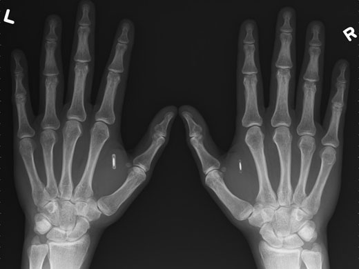 verichip_implant